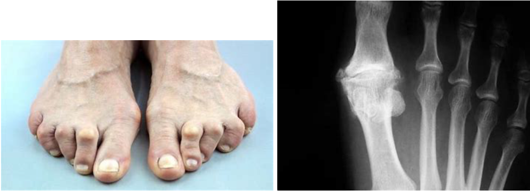 Arthritis-of-the-foot-and-ankle-podiatry-of-arlington-heights
