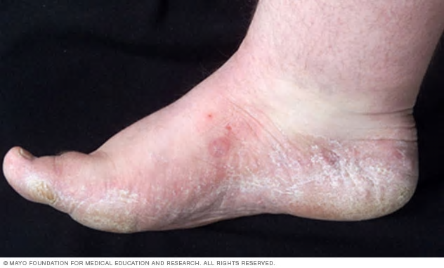 Athletes-foot-treatment-tinea-pedis-maccasin-distribution