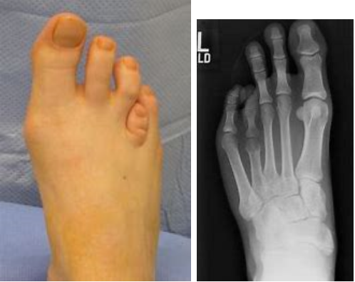 Brachymetatarsia-podiatry-of-arlington-heights.webp