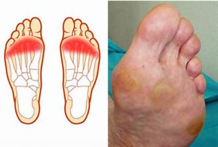 Metatarsalgia-podiatry-of-arlington-heights