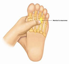 Neuroma-treatment-podiatry-of-arlington-heights-2