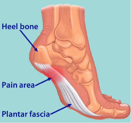 Plantar_Fasciitis