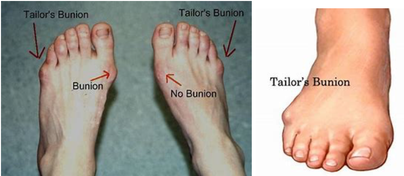 Tailors-Bunion-podiatry-of-arlington-heights