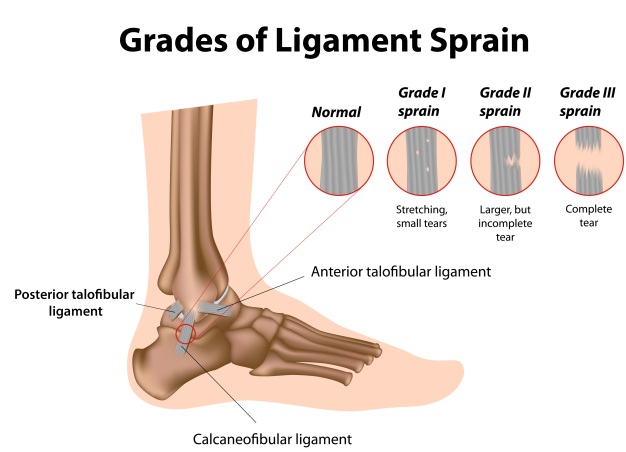 ankle-sprain-treatment-podiatry-of-arlington-heights.webp