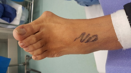 bunion-treatment-podiatry-of-arlington-heights