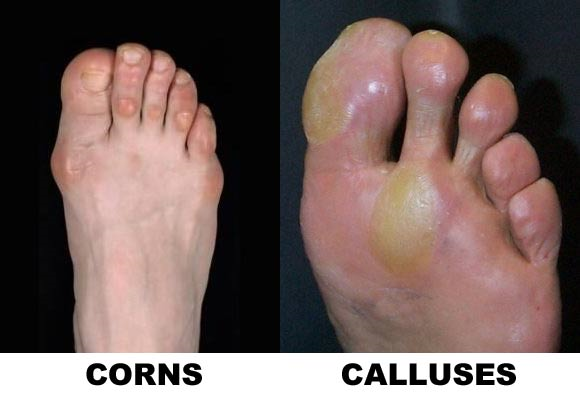 corns-and-callus-treatment-podiatry-of-arlington-heights