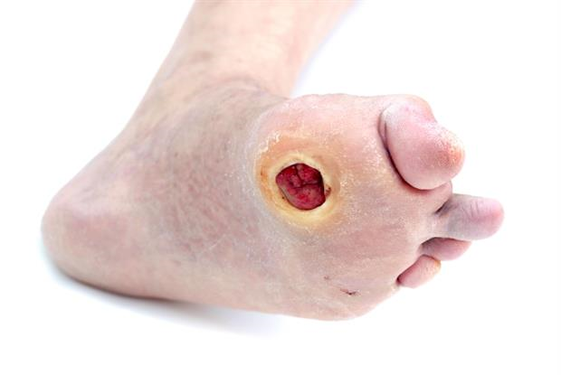 diabetic-foot-wound-care-diabetic-foot-ulceration