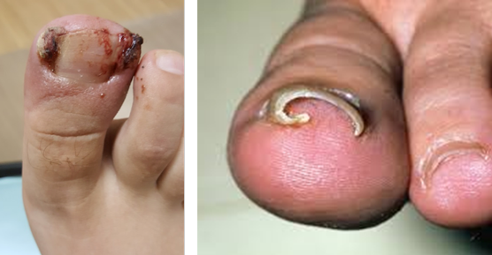 ingrowntoenail-1