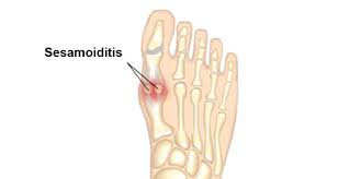 sesamoiditis