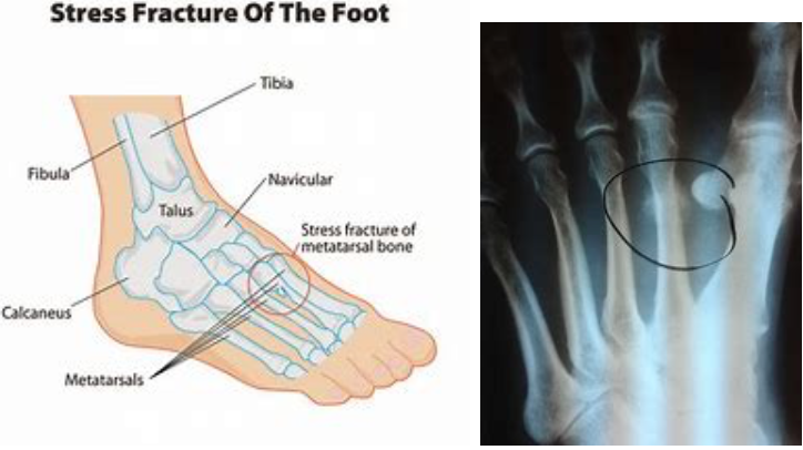 stress-fracture-of-the-foot-podiatry-of-arlington-heights