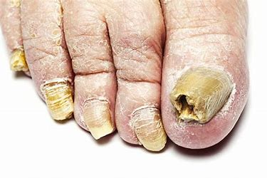 toenail-fungus-treatment-podiatry-of-arlington-heights-2