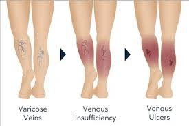 venous-ulcerations