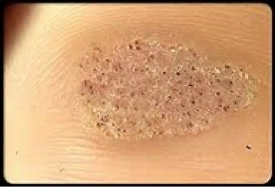 warts