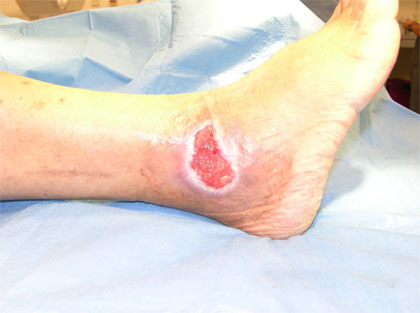 diabetic-wound-care-venous-ulceration-podiatry-of-arlington-heights